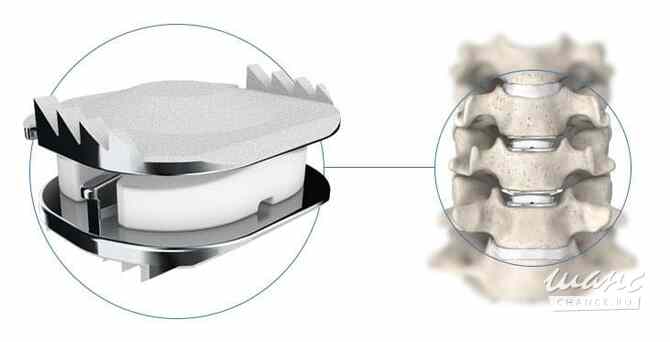 Лучший хирург по замене межпозвоночных дисков в Индии Москва - изображение 2